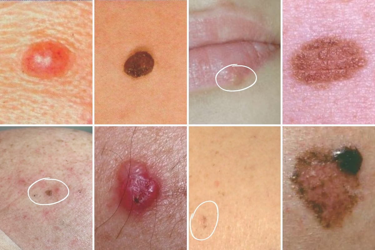 What can skin cancer look like?